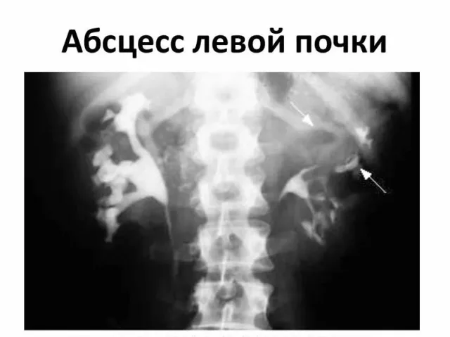 Врачи Люберец успешно вылечили ребёнка от абсцесса почки